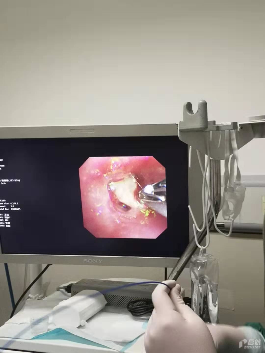 儿童纤维支气管镜治疗