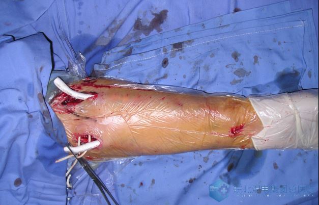 我科2015年成立了以马胜银主任为核心的血液透析血透通路团队,2016年