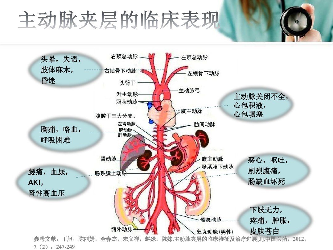 主动脉夹层腔内隔绝术胸腔镜手术皖北总院心胸血管外科,心脏大血管