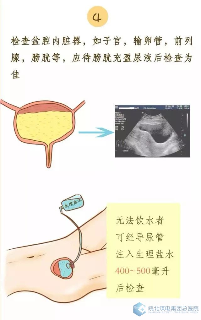 膀胱充盈图片图片