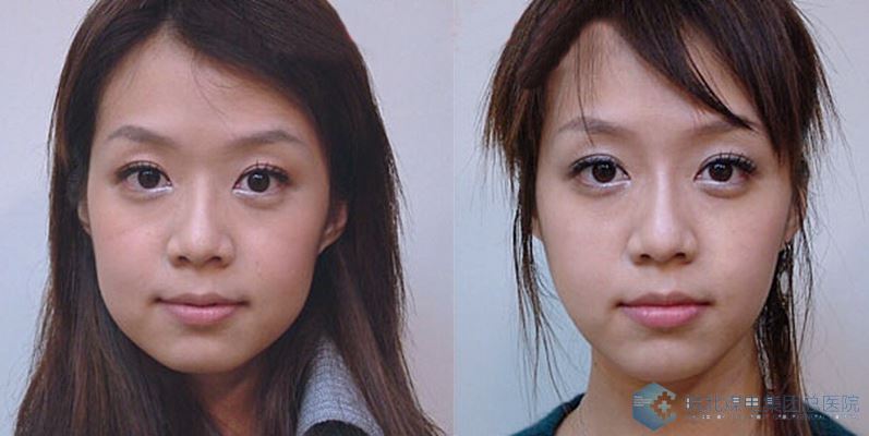 玻尿酸填充额头前后对比图